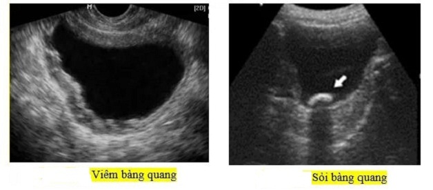 Tìm hiểu về phương pháp siêu âm sỏi bàng quang