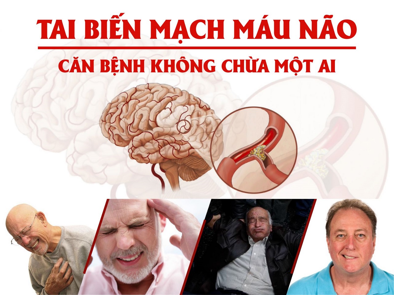 Những điều cần biết về tai biến mạch máu não để phòng tránh hiệu quả |