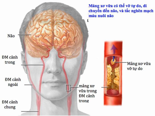 Thiếu máu lên não là gì? Tìm hiểu nguyên nhân, triệu chứng và cách điều trị hiệu quả