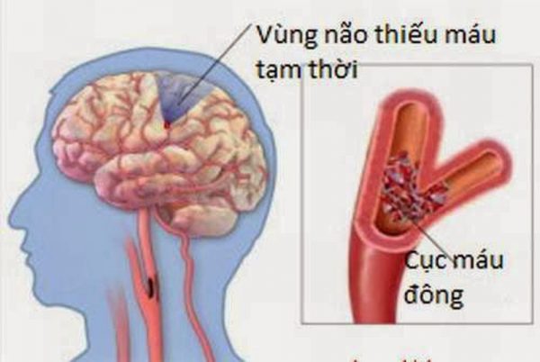 thiếu máu não nguy hiểm không