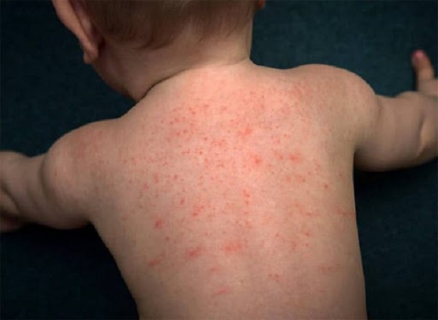 4-year-old-mouth-rash-babycenter