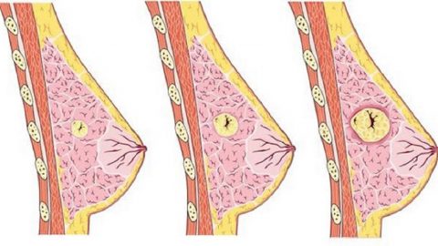 Những điều cần biết về u nang tuyến vú lành tính