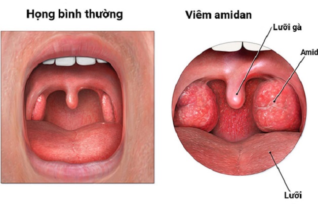 Viêm amidan ở trẻ em: phụ huynh không nên xem nhẹ! | TCI Hospital