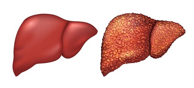 Nồng độ men gan trong máu ở mức cao là biểu hiện các tế bào gan bị hủy hoại