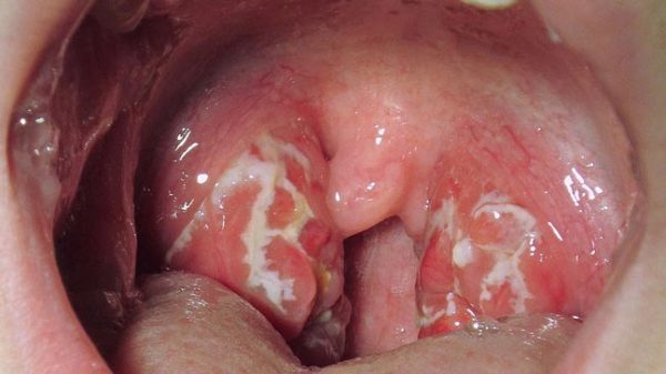 Triệu chứng viêm họng liên cầu khuẩn
