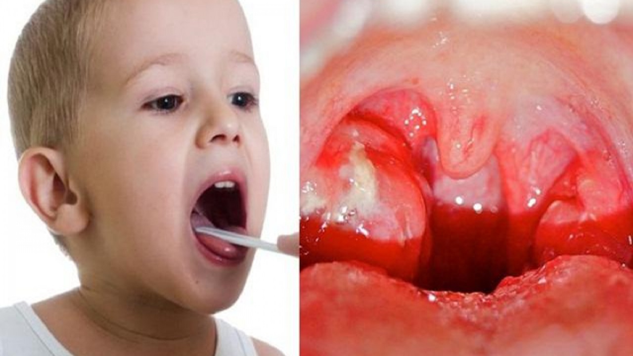 Viêm họng mủ ở trẻ em có triệu chứng như thế nào?
