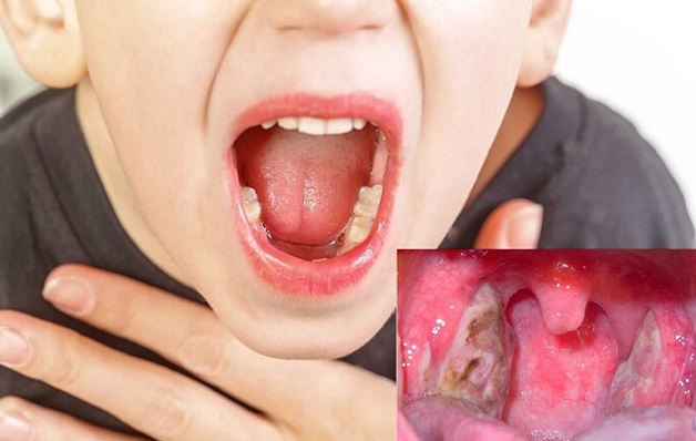 Viêm họng mủ ở trẻ em là hiện tượng lớp niêm mạc ở thành họng phình to, chứa mủ trắng.