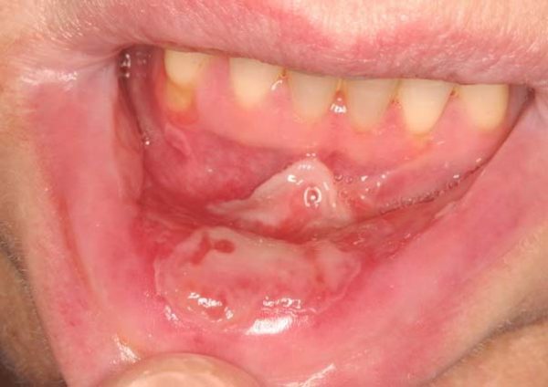Bệnh viêm niêm mạc miệng có thể điều trị hiệu quả bằng cách nào?