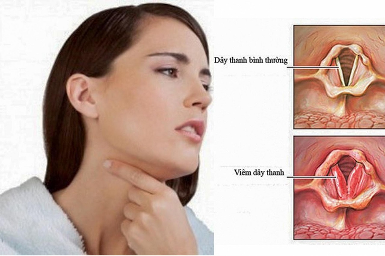 Triệu chứng viêm họng thanh quản mãn tính là gì?