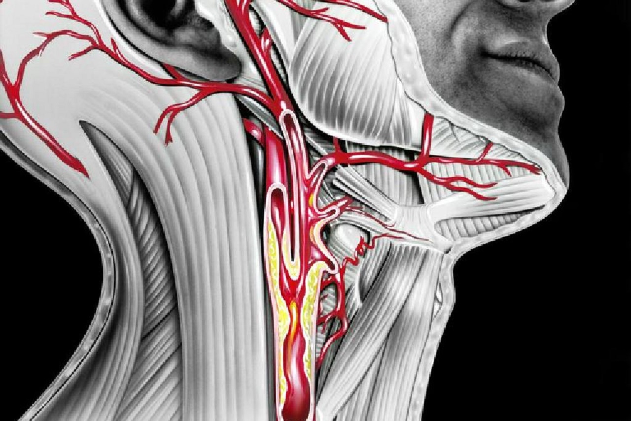 Бляшки в сосудах шейного отдела. Каротидная бифуркация анатомия. Поражение сонной артерии. Каротидный атеросклероз.