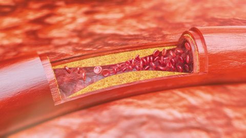 Xơ vữa mạch vành: Nguyên nhân, chẩn đoán và cách điều trị