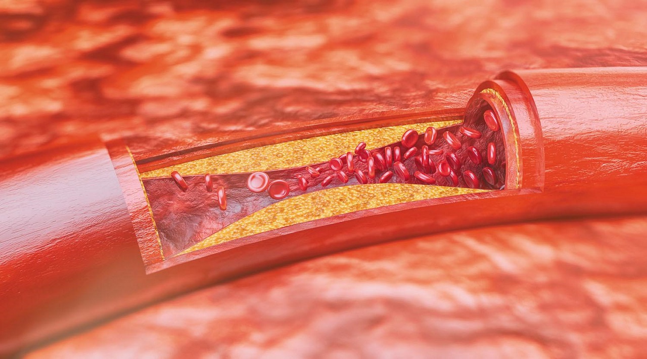 Nguyên nhân gây bệnh xơ vữa đông mạch vành là gì?
