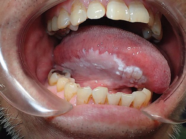 Bệnh bạch sản niêm mạc miệng điều trị thế nào? | TCI Hospital