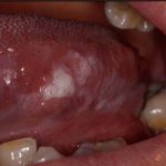 Bệnh bạch sản niêm mạc miệng điều trị thế nào?