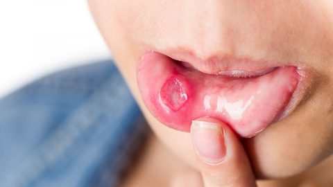 Bệnh loét niêm mạc miệng: những điều cần biết