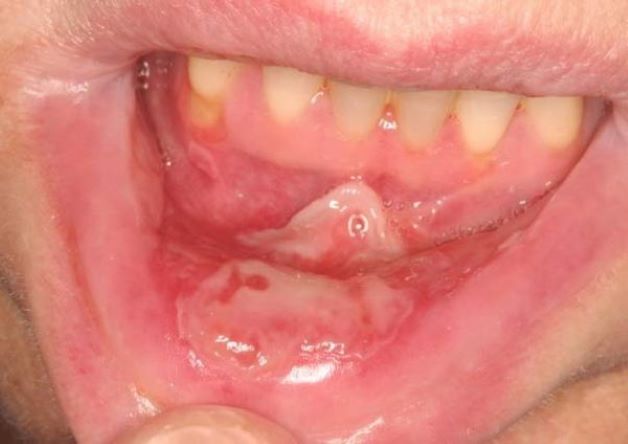 Bệnh loét niêm mạc miệng: Nguyên nhân và phương pháp điều trị