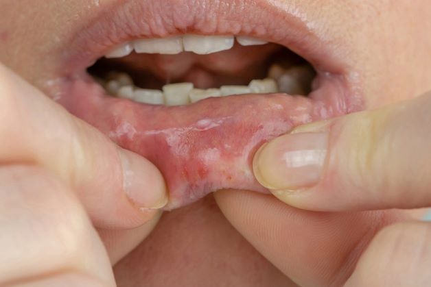 Bệnh loét niêm mạc miệng: Nguyên nhân và phương pháp điều trị