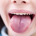 Bệnh sản niêm mạc miệng có những triệu chứng như thế nào?