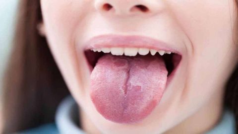 Bệnh sản niêm mạc miệng có những triệu chứng như thế nào?