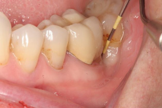 Viêm cuống răng là bệnh lý về răng miệng phổ biến và gây đau đớn, ảnh hưởng đến sinh hoạt và sinh hoạt của người bệnh