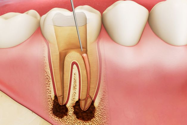 Viêm tủy, tủy hoại tử là nguyên nhân dẫn đến biến chứng là viêm quanh cuống răng.