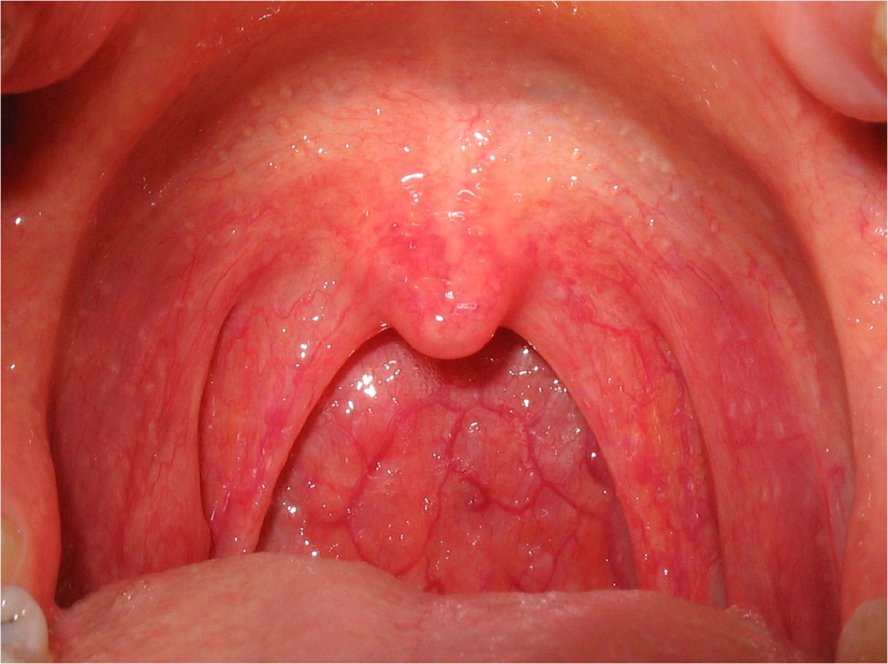 Đau họng có phải là triệu chứng của viêm họng?
