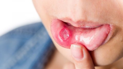 Bệnh viêm loét niêm mạc miệng: Nguyên nhân và cách điều trị