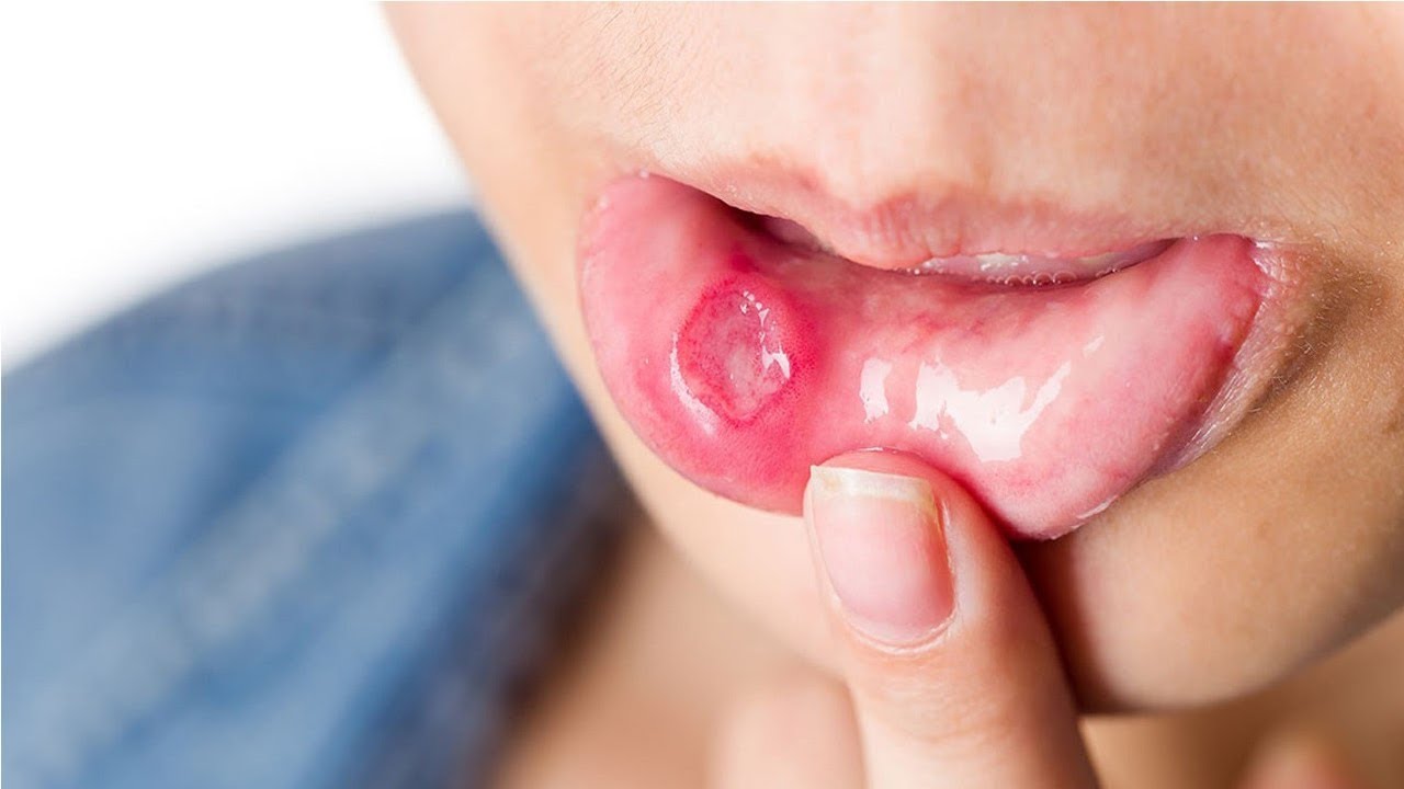 Triệu chứng của lở miệng như thế nào?
