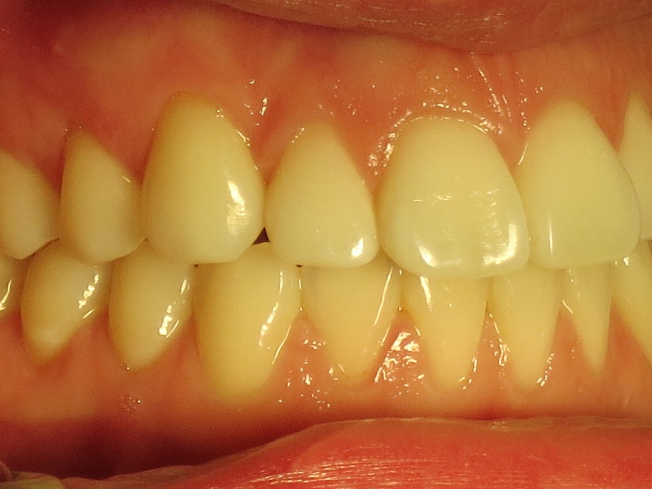 Làm thế nào để ngăn ngừa răng bị vàng đen?

