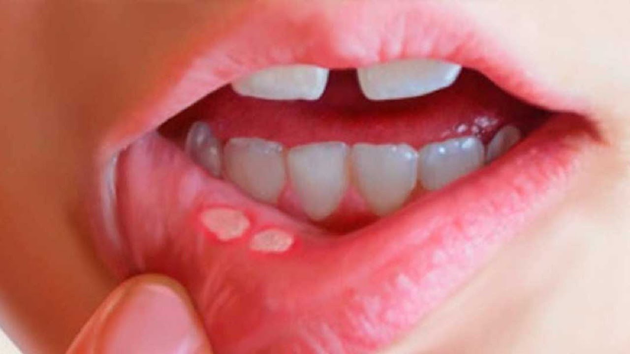 Chữa nhiệt miệng cho trẻ: các cách chữa trị hiệu quả nhất