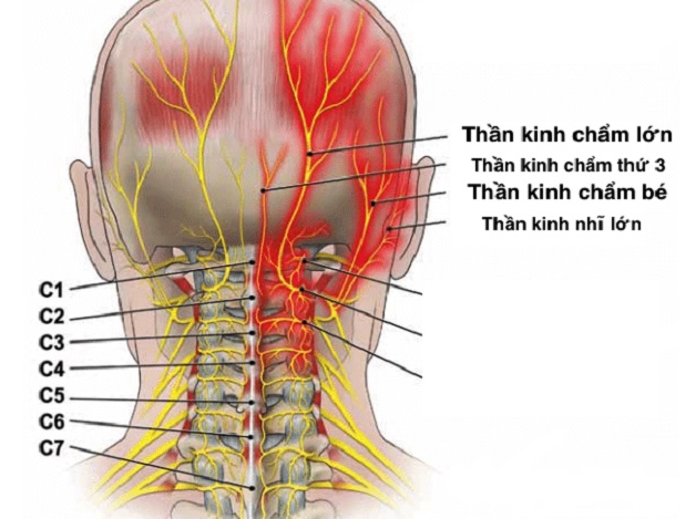 Thông tin về bệnh đau đầu Arnold