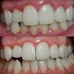5 dấu hiệu viêm nha chu – Chớ coi thường kẻo mất răng
