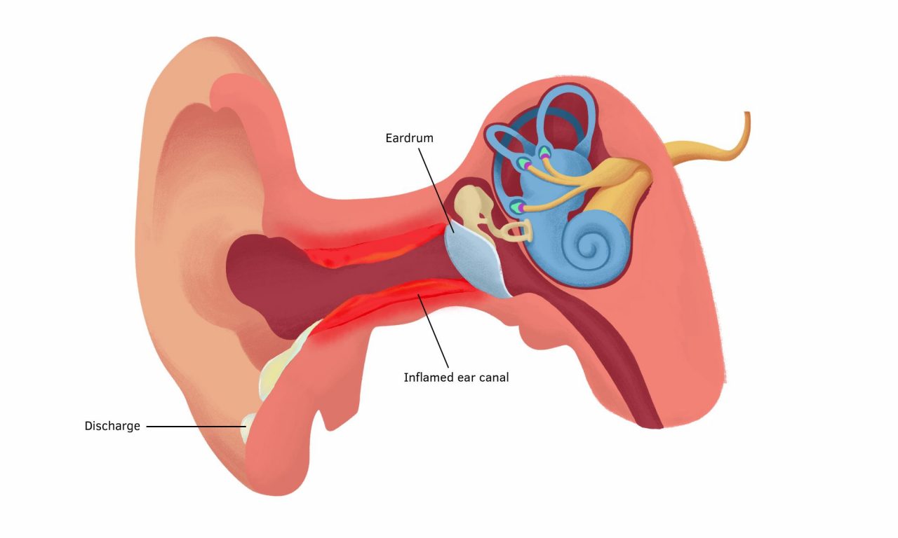 Có bất kỳ nguyên nhân nào đặc biệt nào làm tăng nguy cơ mắc viêm vành tai ngoài?

Xin lưu ý rằng đây chỉ là ví dụ và không có sự thẩm định từ một chuyên gia y tế, vì vậy hãy tra cứu thông tin thêm từ các nguồn đáng tin cậy trước khi sử dụng thông tin này.