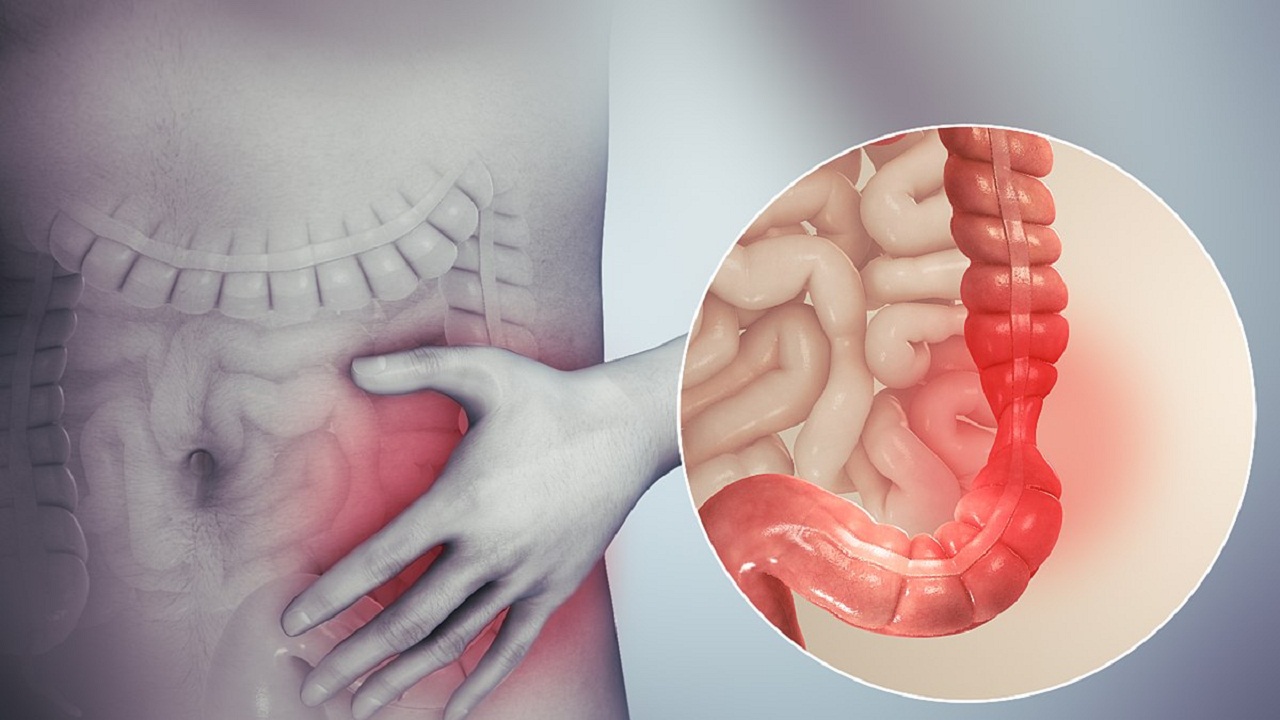 Hội chứng ruột kích thích có liên quan đến căn bệnh nào khác không? (Is irritable bowel syndrome associated with any other conditions or diseases?)
