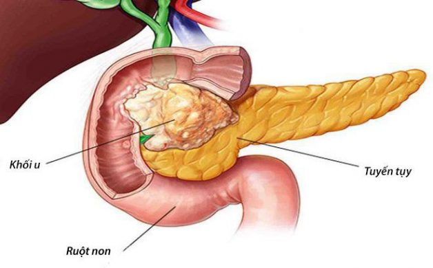 Ung Thư Tụy Giai Đoạn Đầu: Dấu Hiệu, Nguyên Nhân và Phương Pháp Điều Trị Hiệu Quả