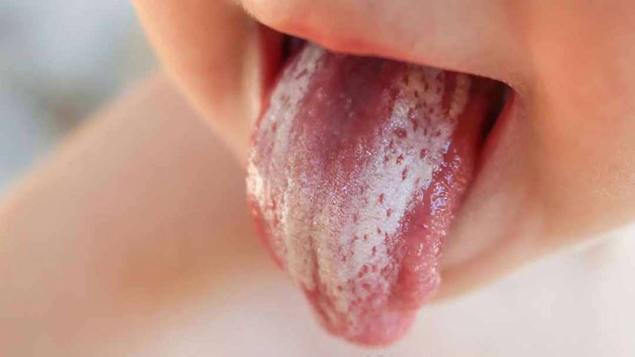 Nấm miệng Candida có nguy hiểm không? | TCI Hospital
