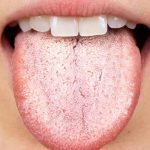 Nấm miệng Candida là bệnh gì?