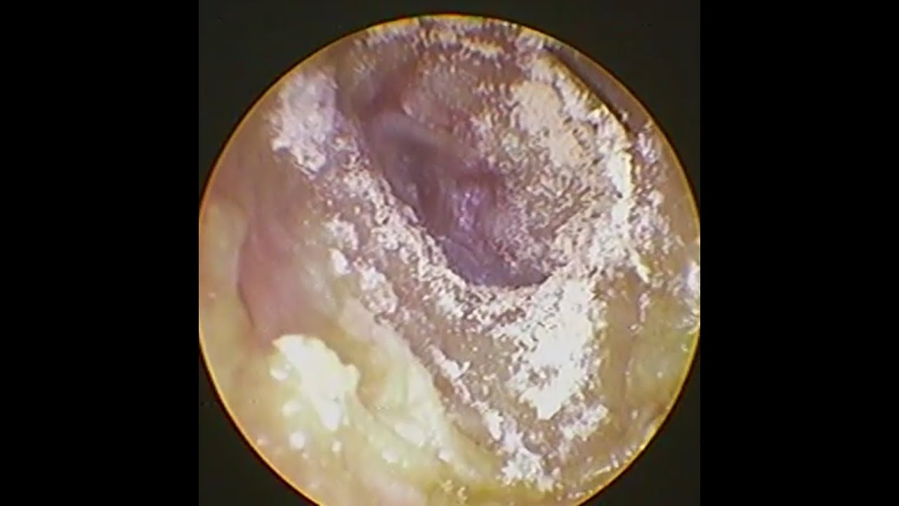 Hình ảnh nội soi nấm ống tai