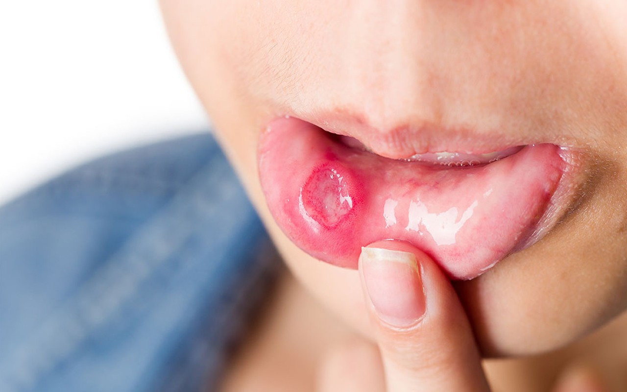 Làm sao để ngăn ngừa lở miệng?
