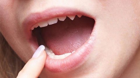 Nhiệt miệng dưới lưỡi và ung thư lưỡi: Cẩn thận kẻo nhầm lẫn