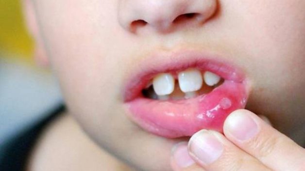 Nhiệt miệng ở trẻ em là một bệnh thường gặp và không quá nguy hiểm
