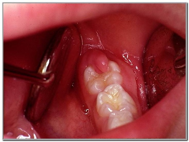 Những lưu ý khi nhổ răng số 8 để tránh biến chứng | TCI Hospital