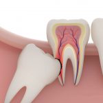 Những lưu ý khi nhổ răng số 8 để tránh biến chứng 