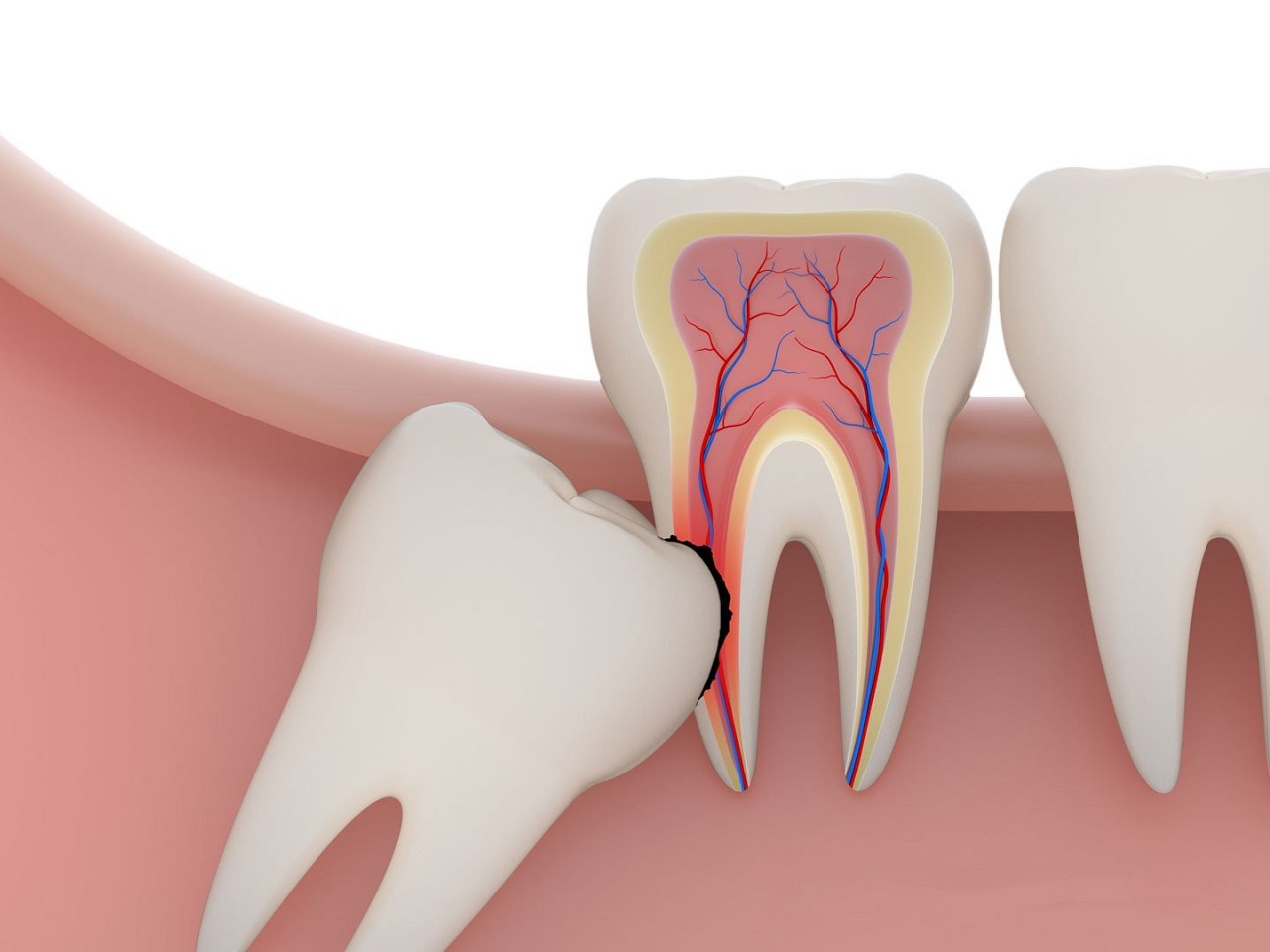 Lưu ý khi nhổ răng số 8 liên quan đến việc gì?
