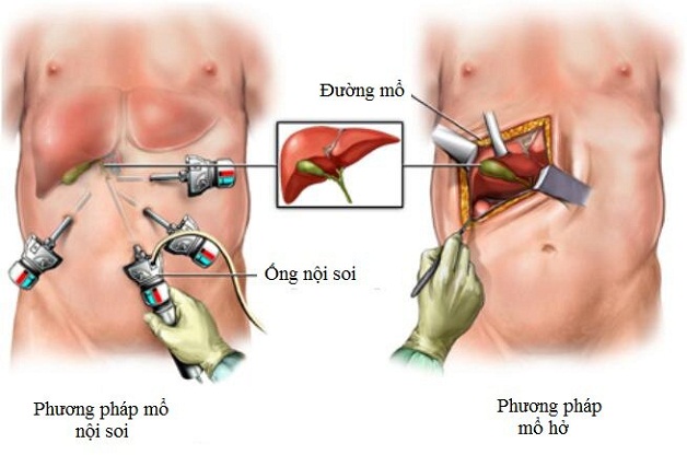 Phẫu thuật cắt polyp túi mật 10mm bằng mổ mở hoặc mổ nội soi