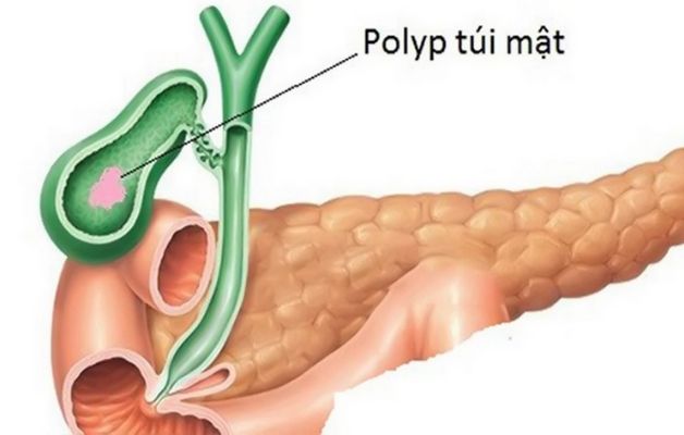 Polyp túi mật và cách điều trị như thế nào