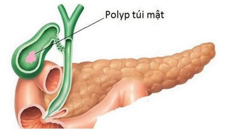 Những điều cần biết về Polyp túi mật và cách điều trị