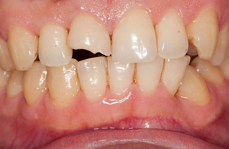 Răng bị bể lớn có bọc sứ được không là chủ đề nhiều người quan tâm