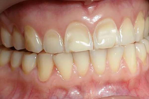 Nhiều khách hàng bị xỉn màu răng đã lựa chọn răng sứ Cercon như một phương pháp lâu dài và vĩnh viễn để thay thế răng thật
