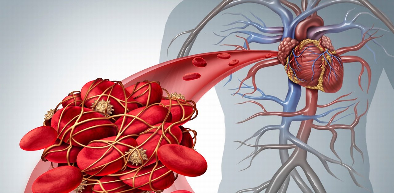 Bệnh mạch vành tim có tác động đến chế độ ăn uống như thế nào? 
